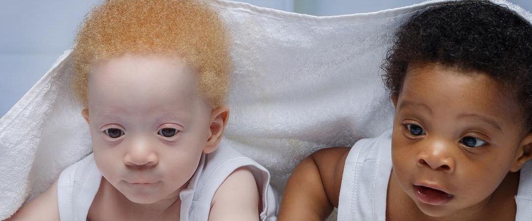 Casal nigeriano tem filhos gêmeos, um deles branco, e causam supresa nas redes sociais